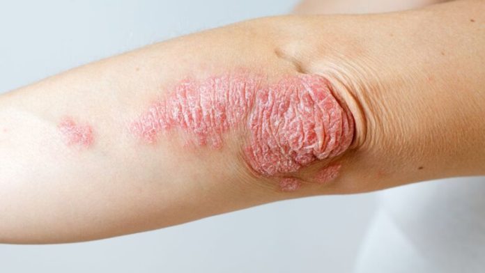 psoriasis 1280 782x440 1.jpg